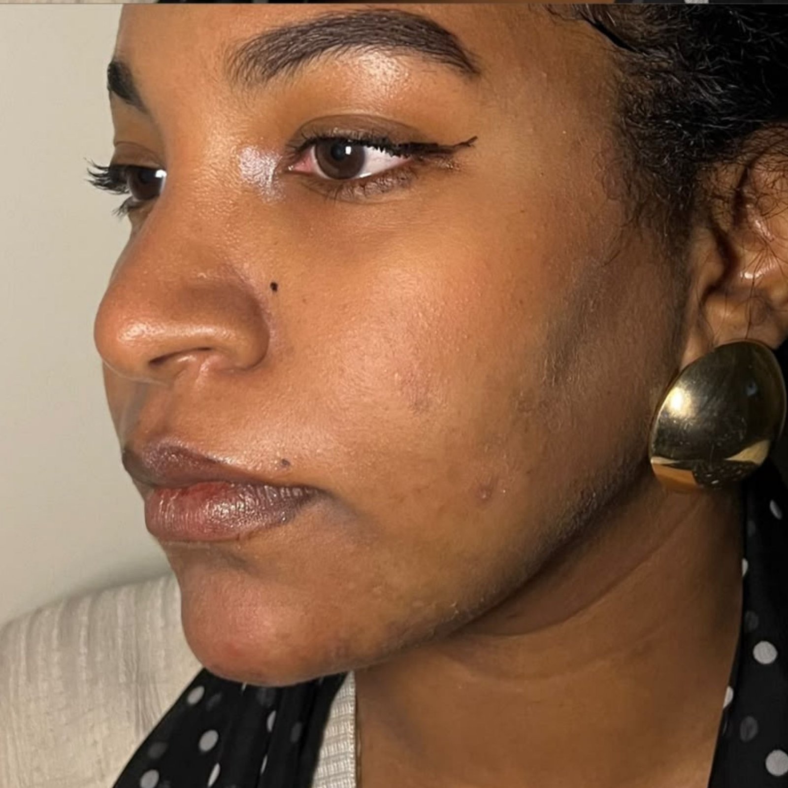 Full Face Filler before