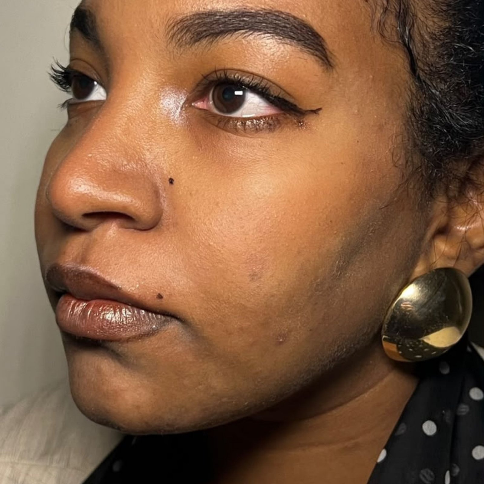 Full Face Filler after