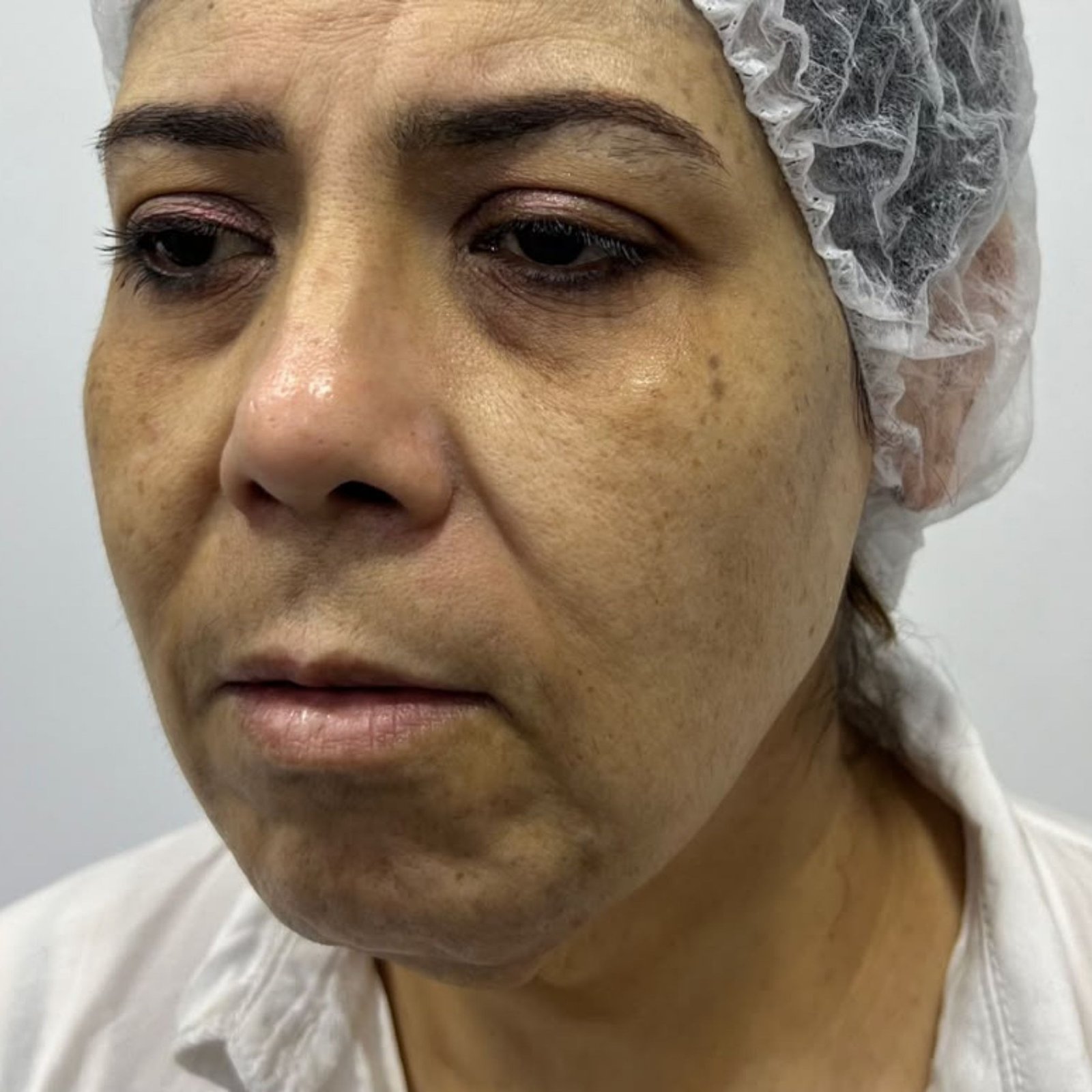 Full Face Filler before