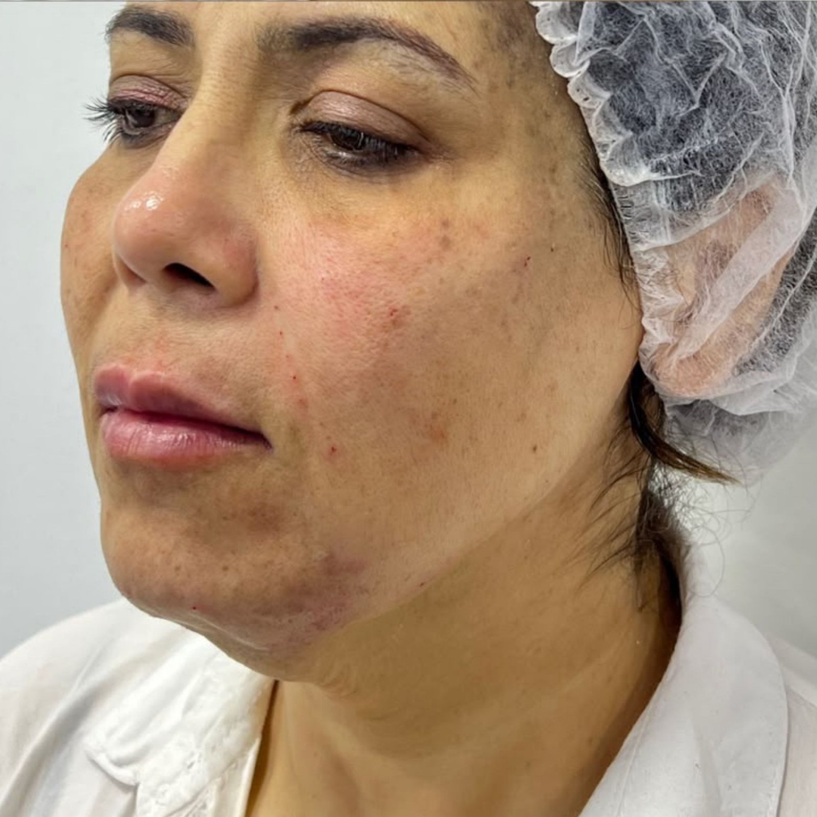 Full Face Filler after