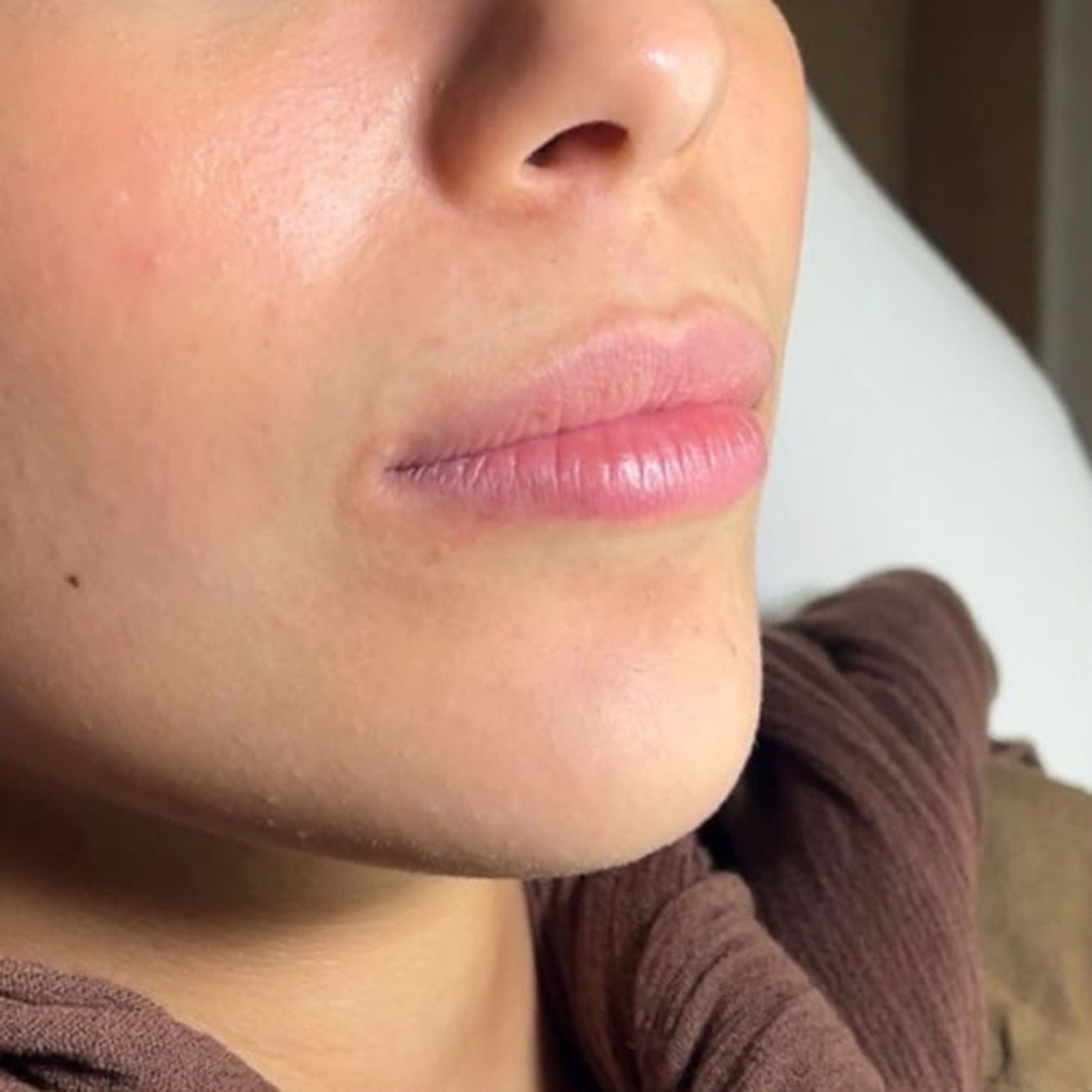 Lip Filler before