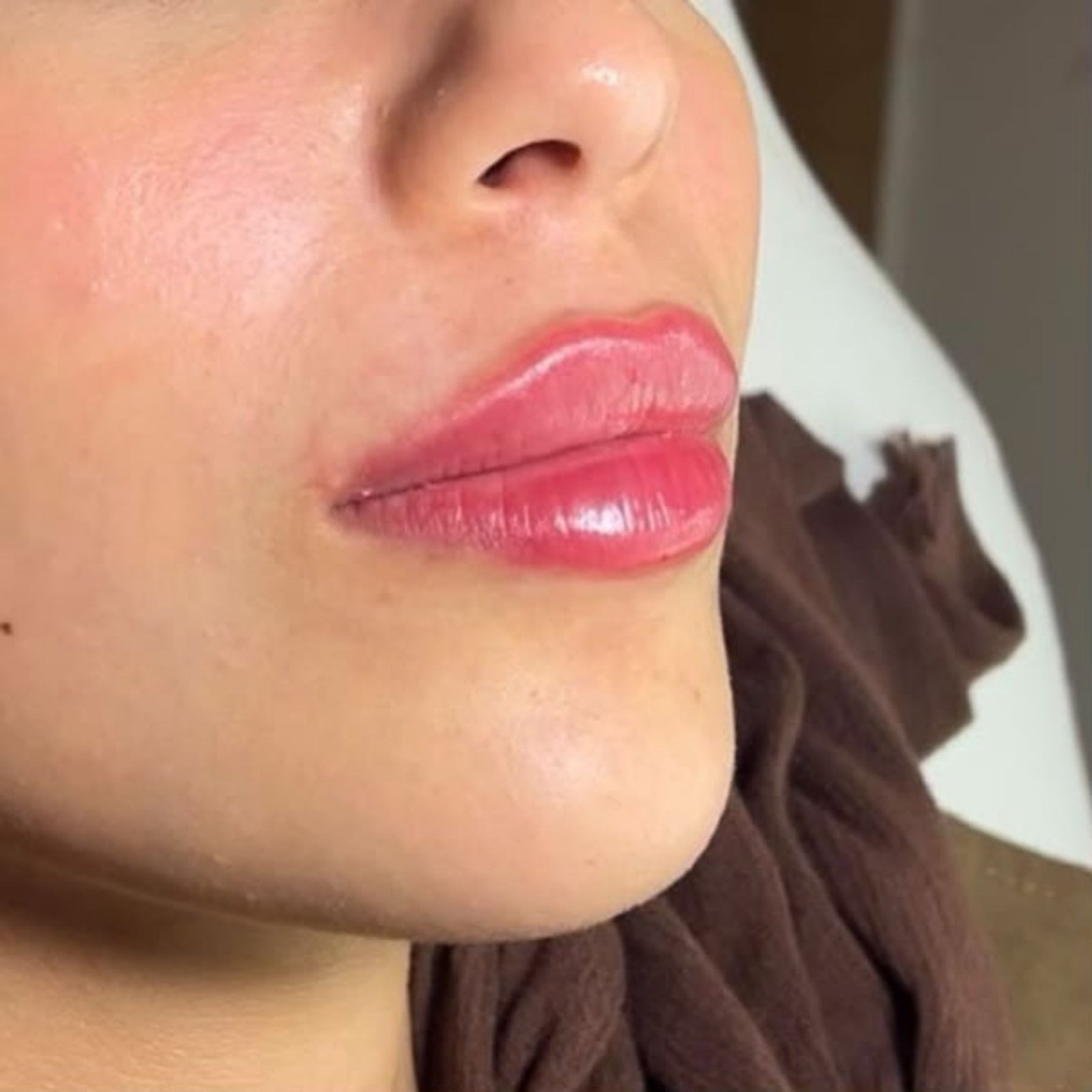 Lip Filler after