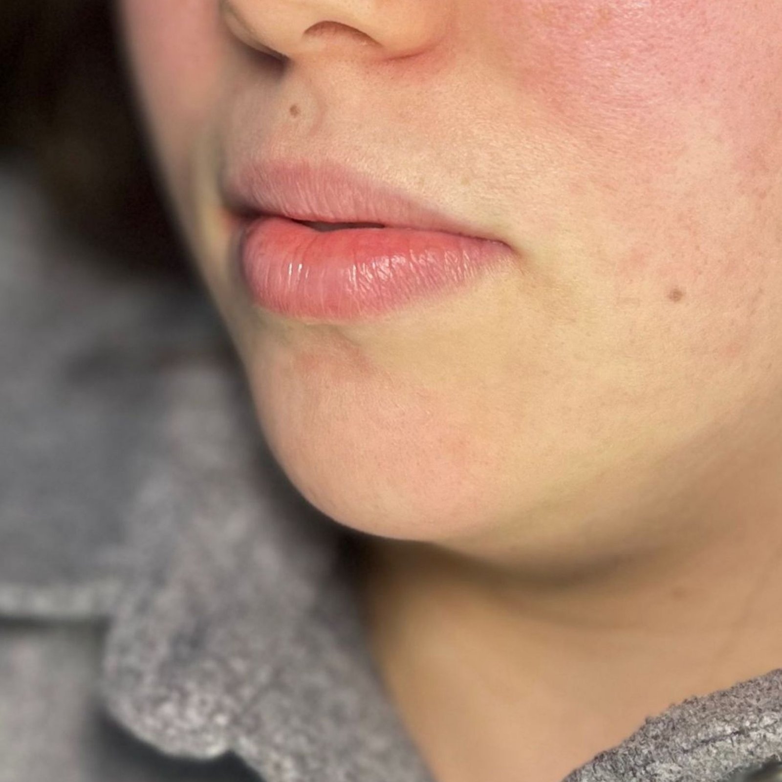 Lip Filler before
