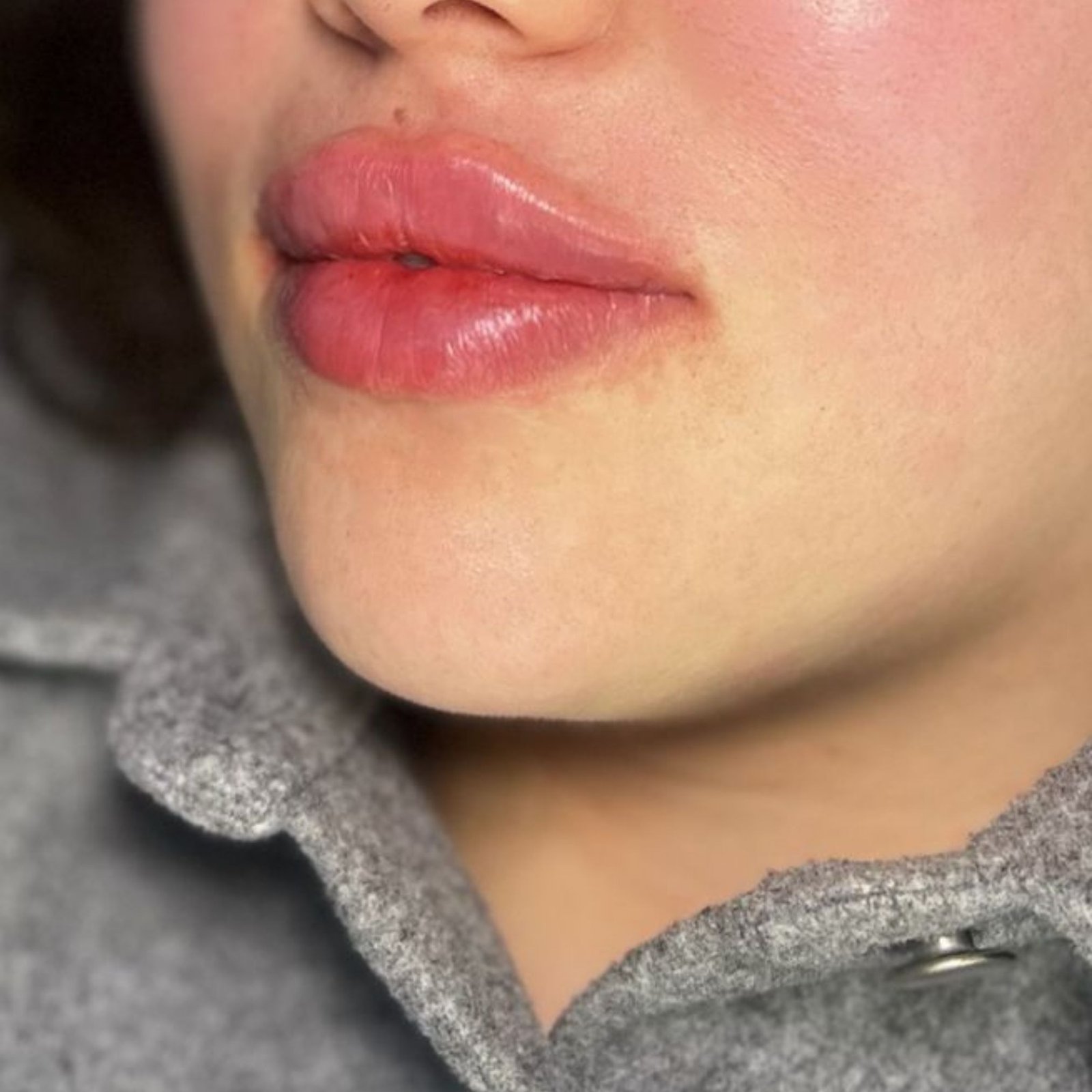 Lip Filler after