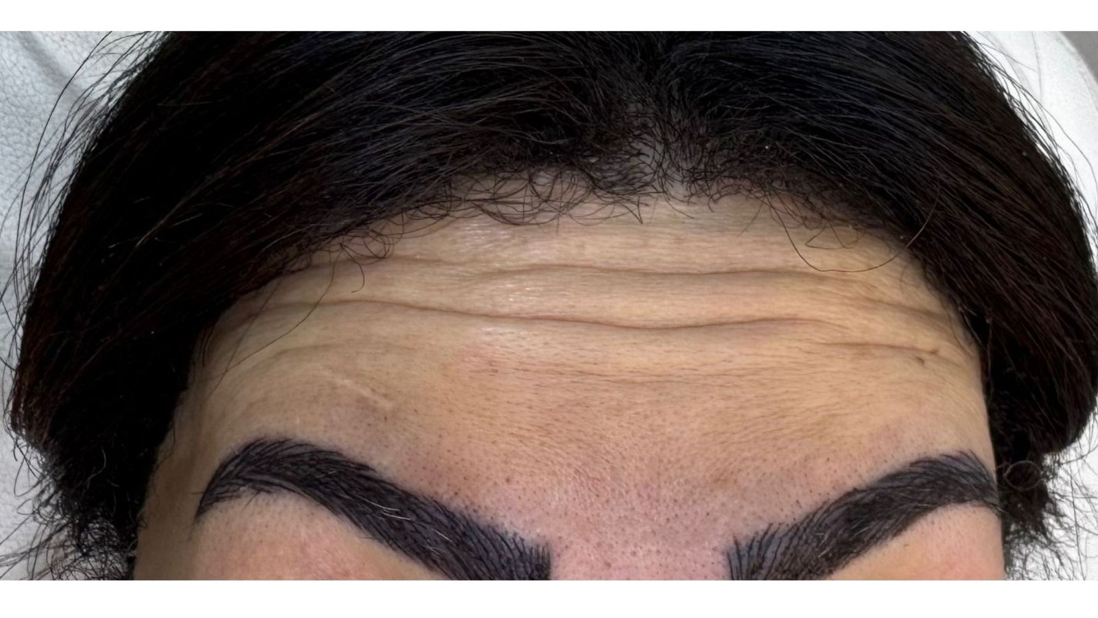 Botox before