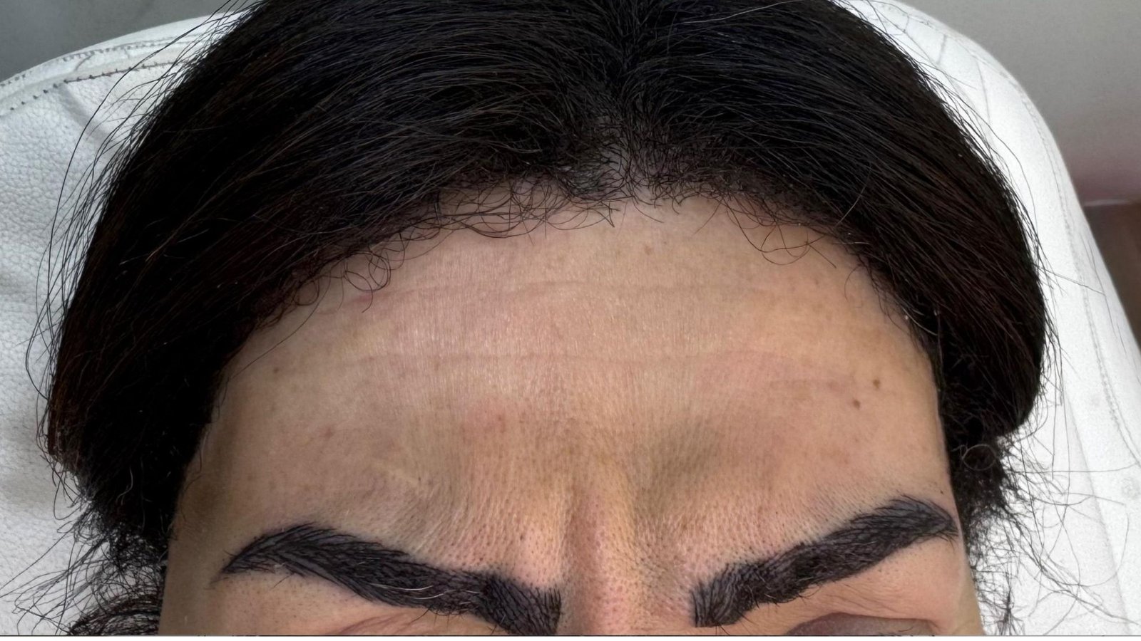 Botox after