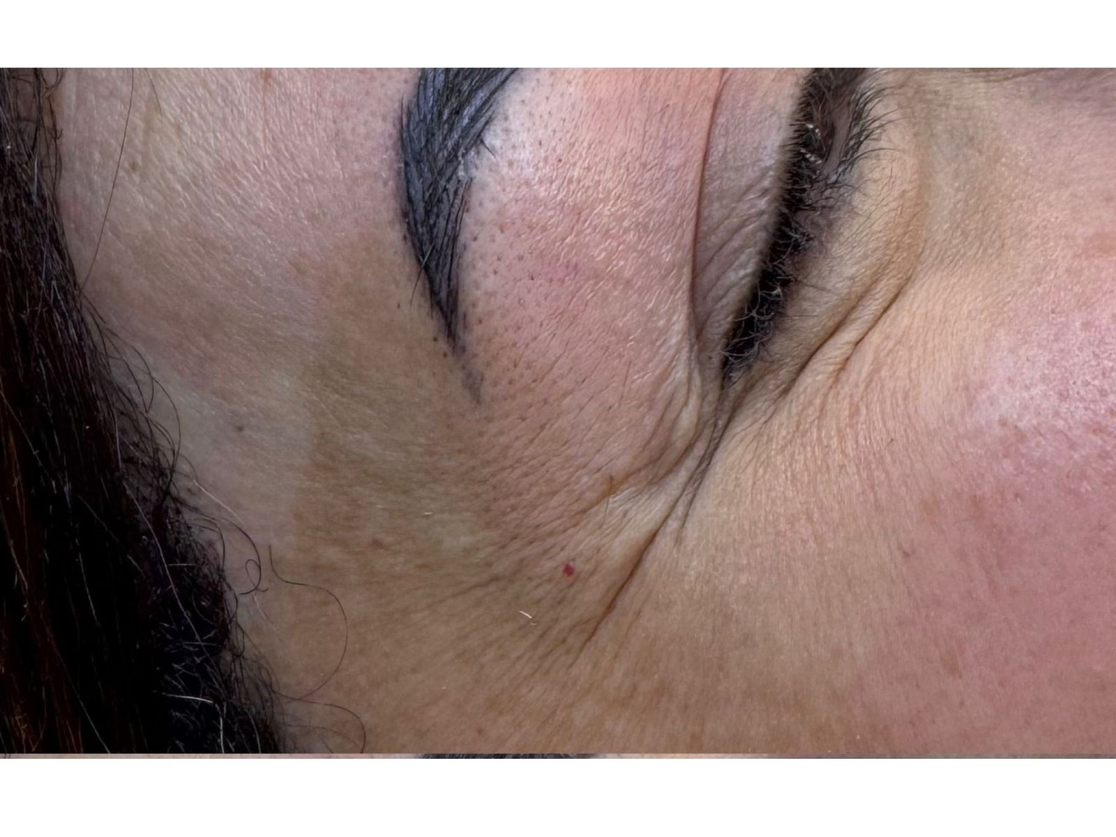 Botox before