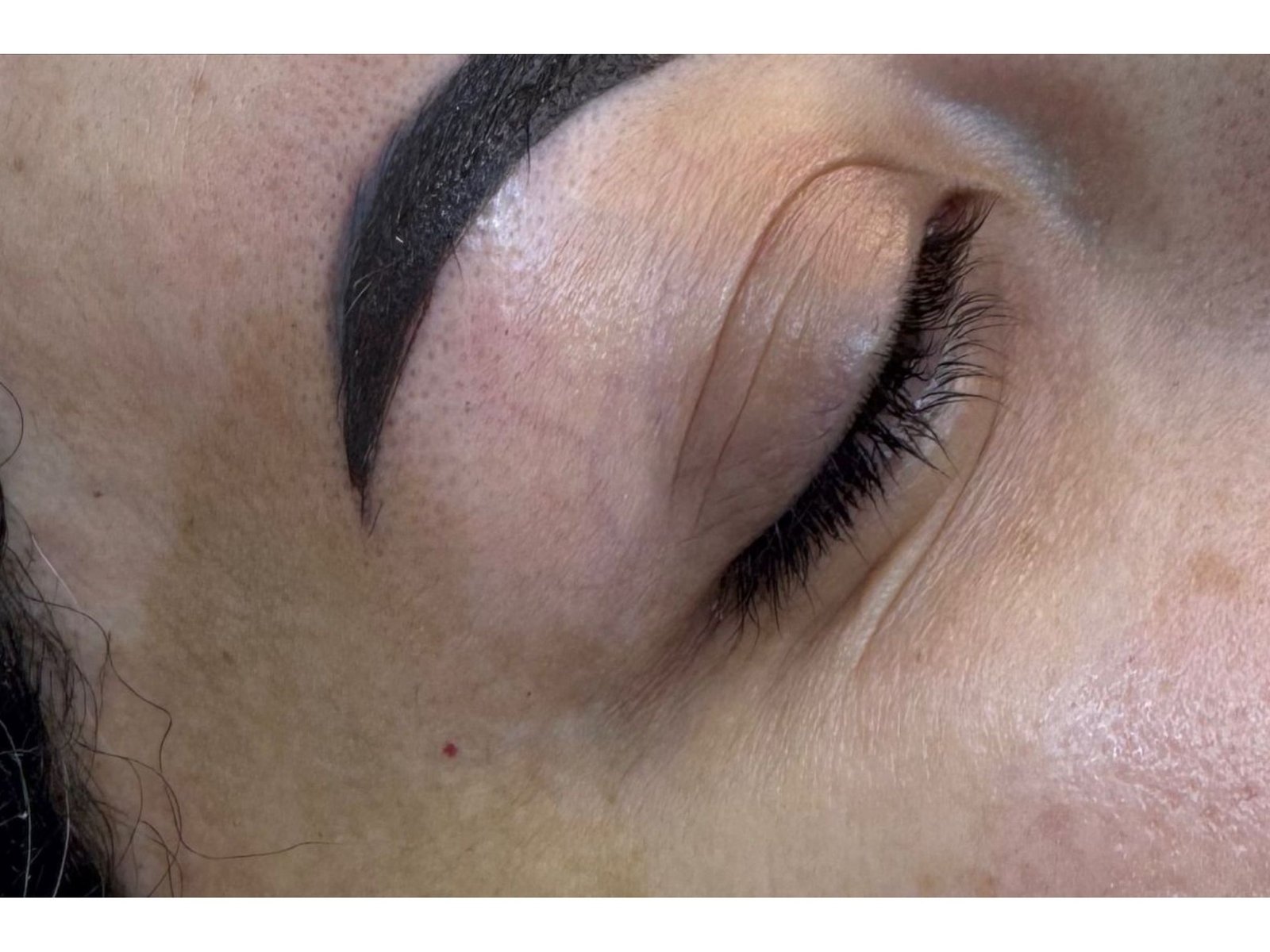 Botox after