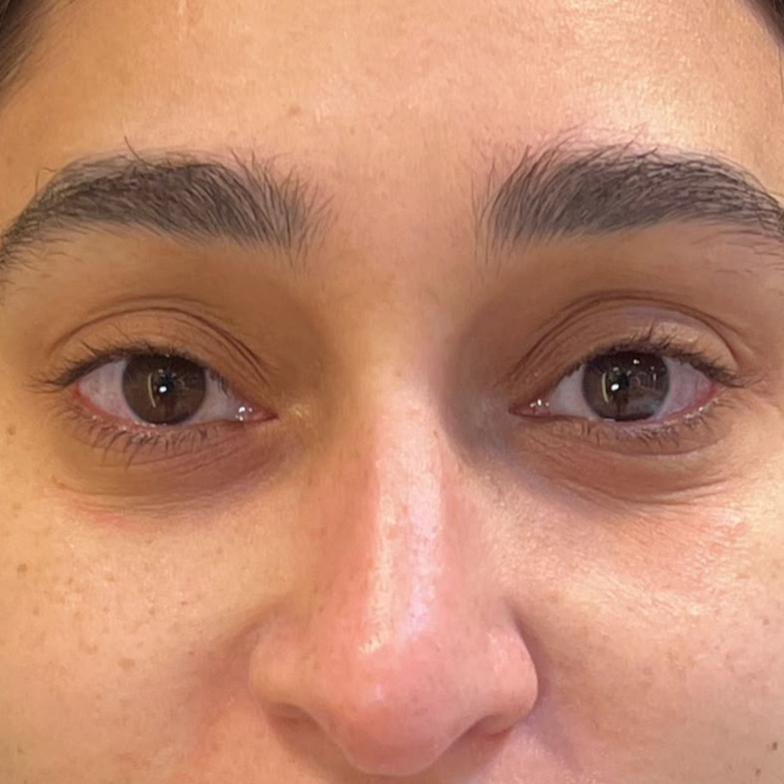 Tear Trough filler before