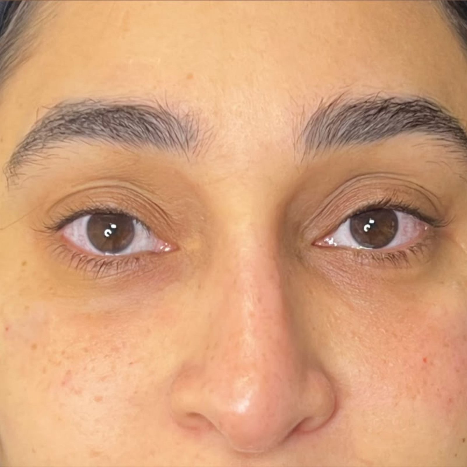 Tear Trough filler after