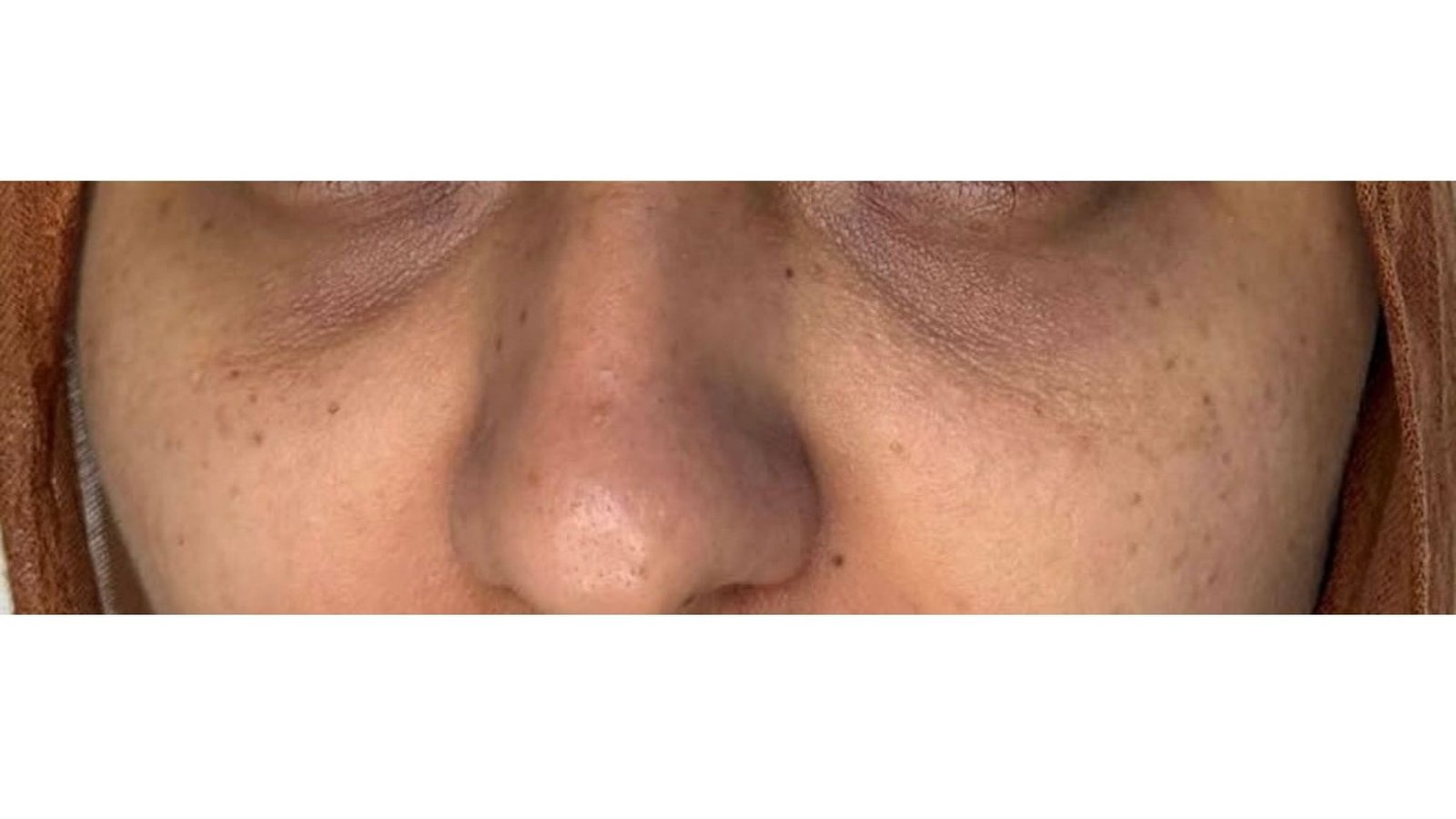 Tear Trough Filler before