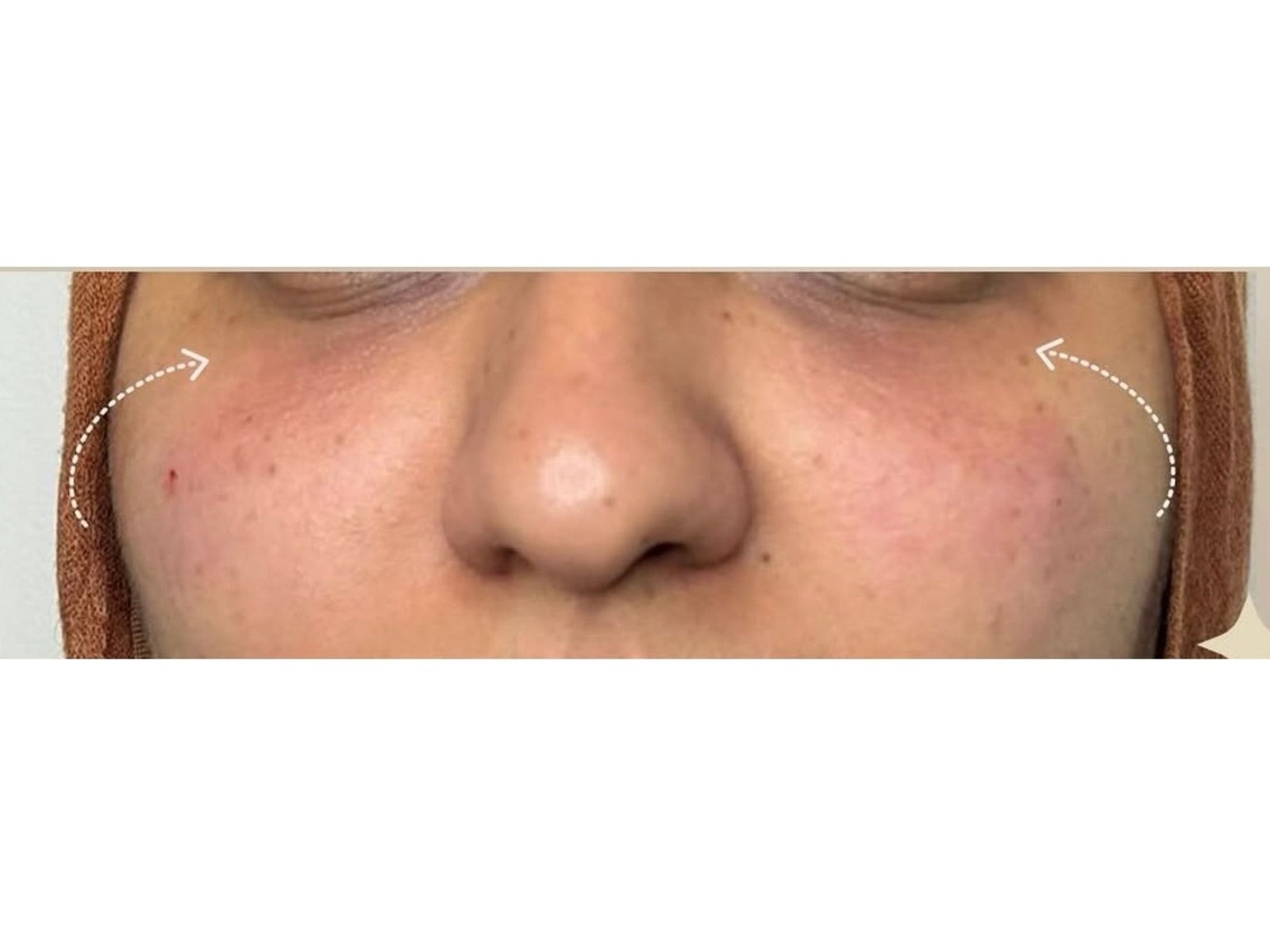Tear Trough Filler after