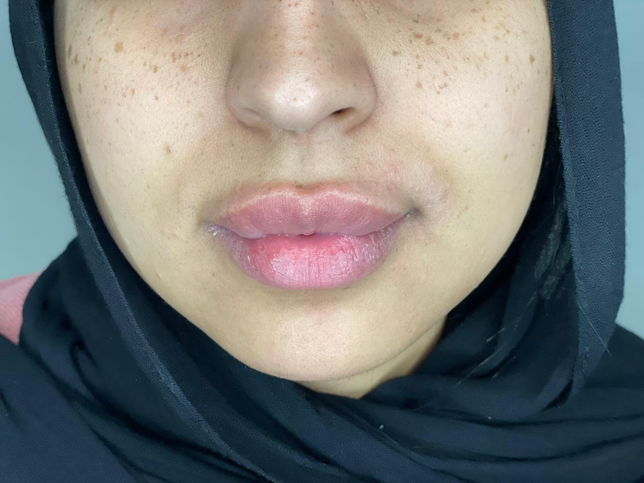 Chin Filler before