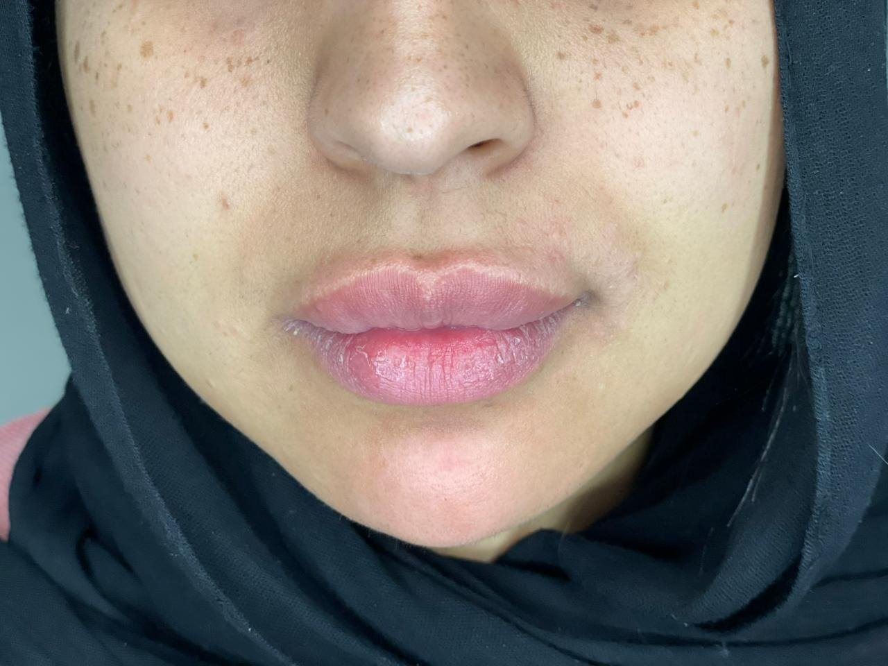 Chin Filler after