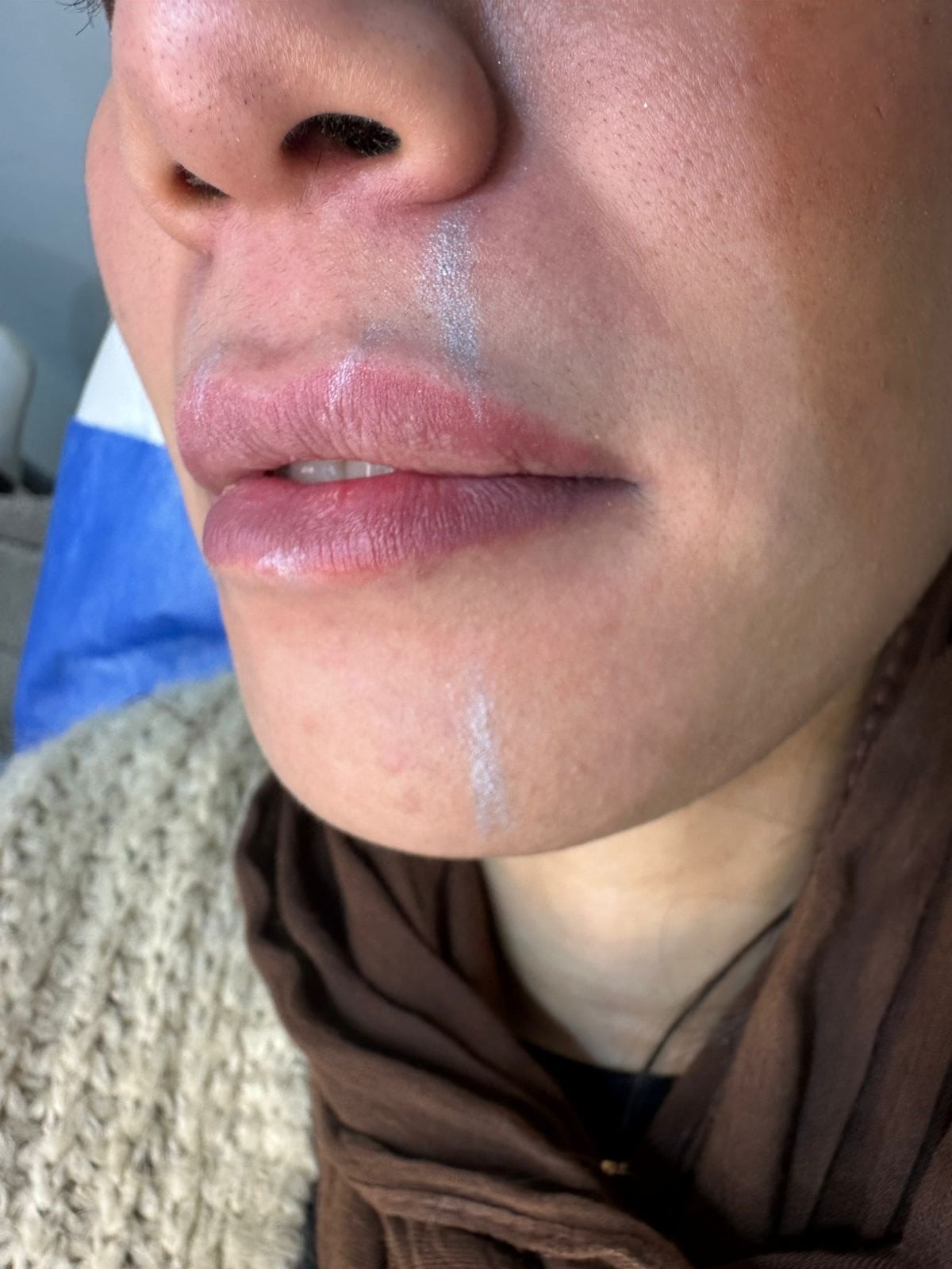 Lip Filler before