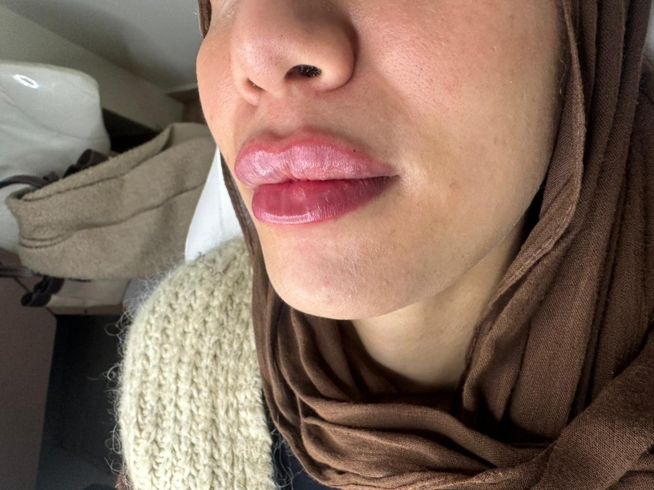 Lip Filler after