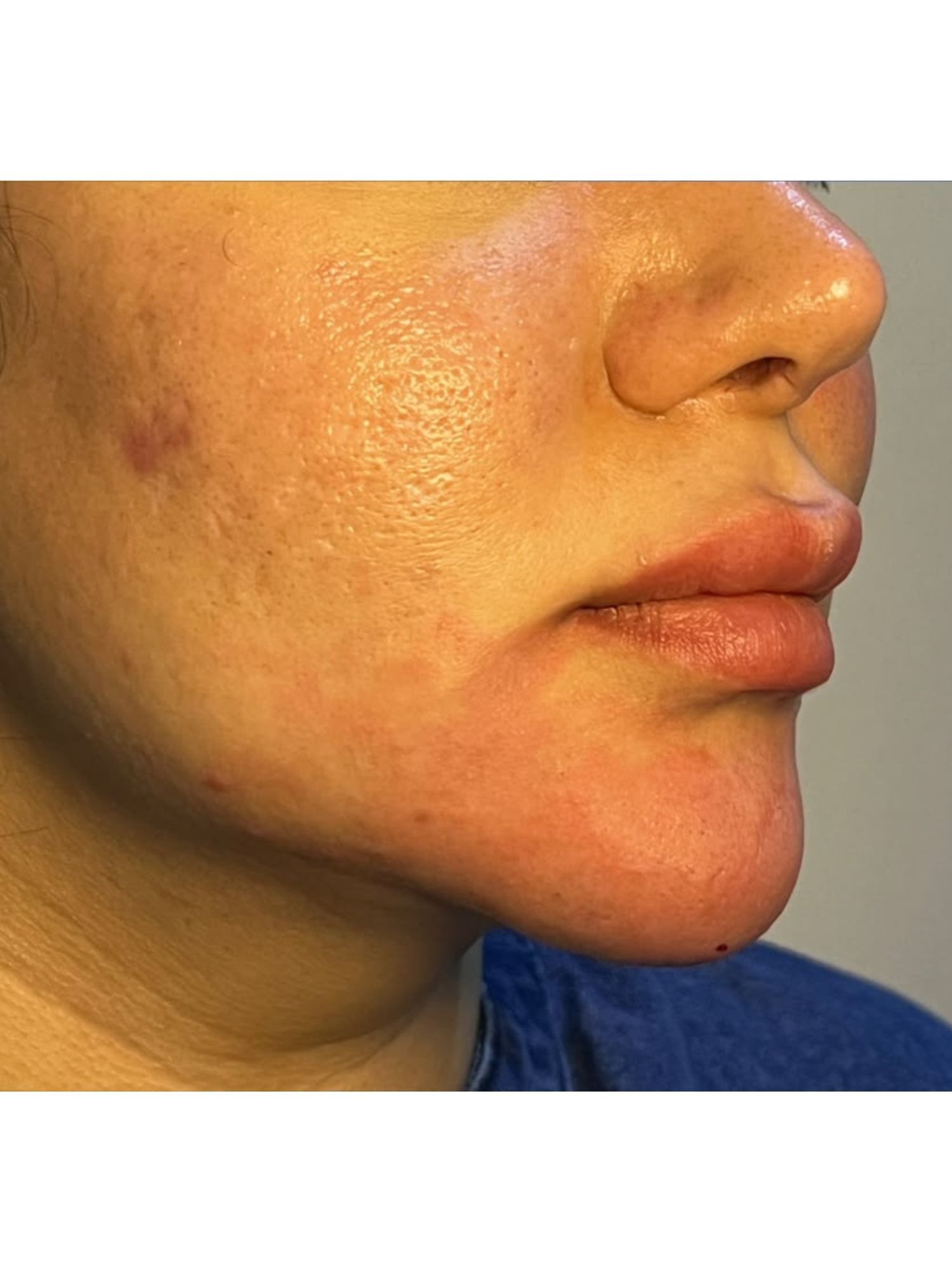 Cheeks and chin fillers after