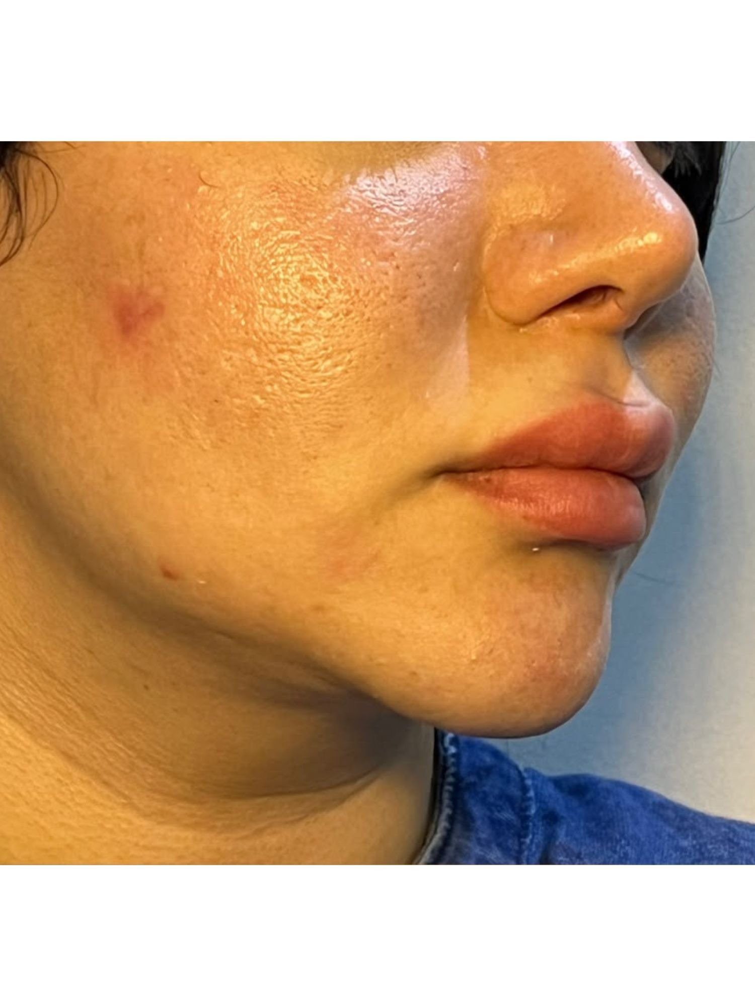 Cheeks and chin fillers before