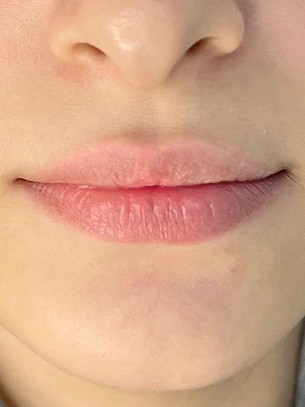 Lip Filler before