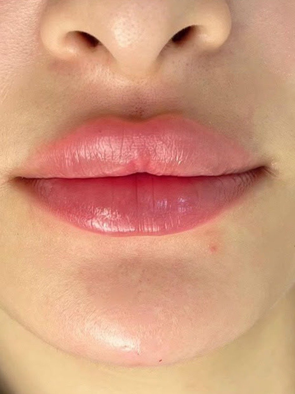 Lip Filler after