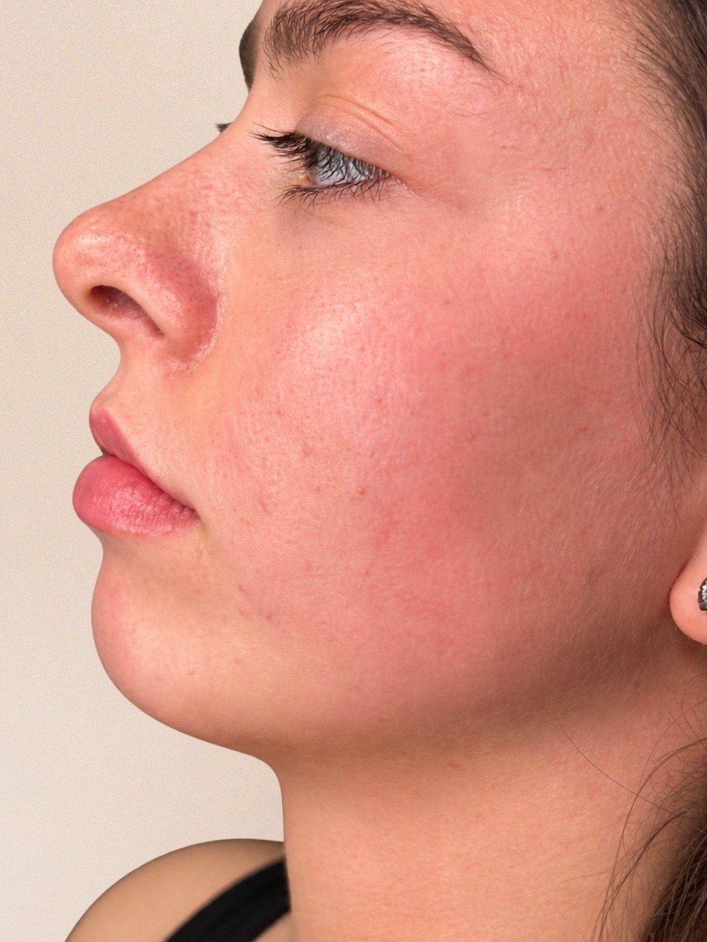 Jawline and Chin Filler before