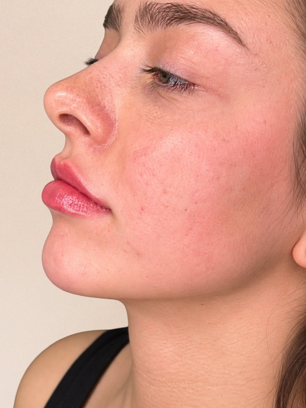 Jawline and Chin Filler after