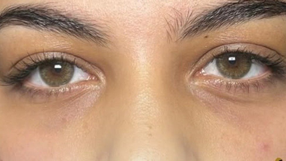 Tear Trough Filler after