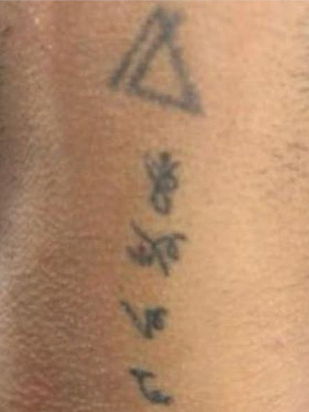 Tatto Removal before