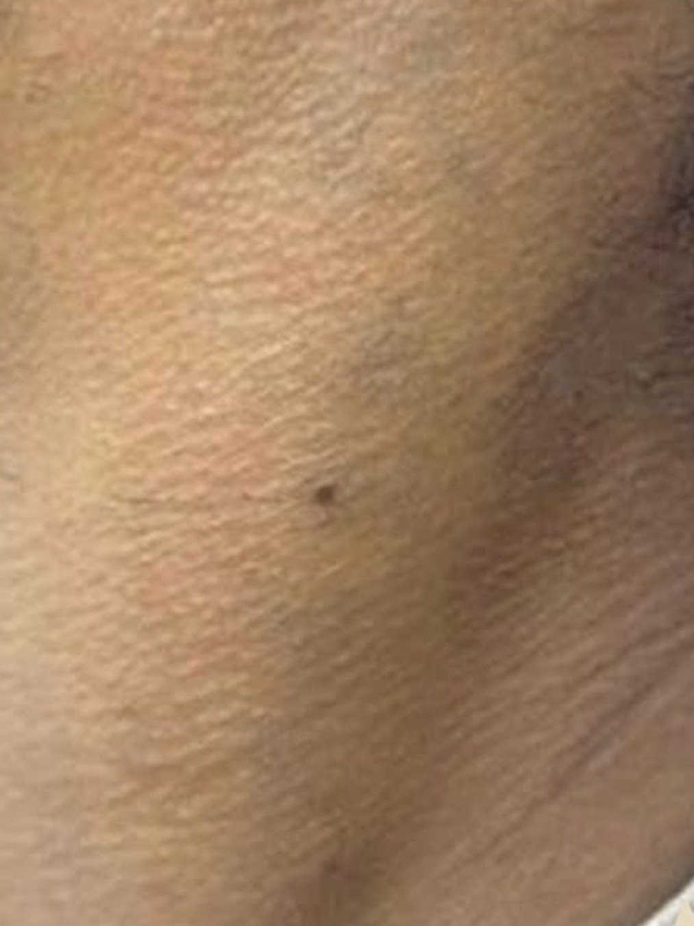 Tatto Removal after